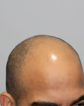 Before: Hairline restoration