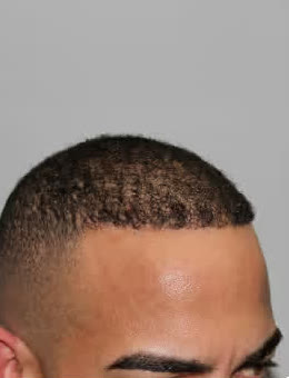 After: Hairline restoration